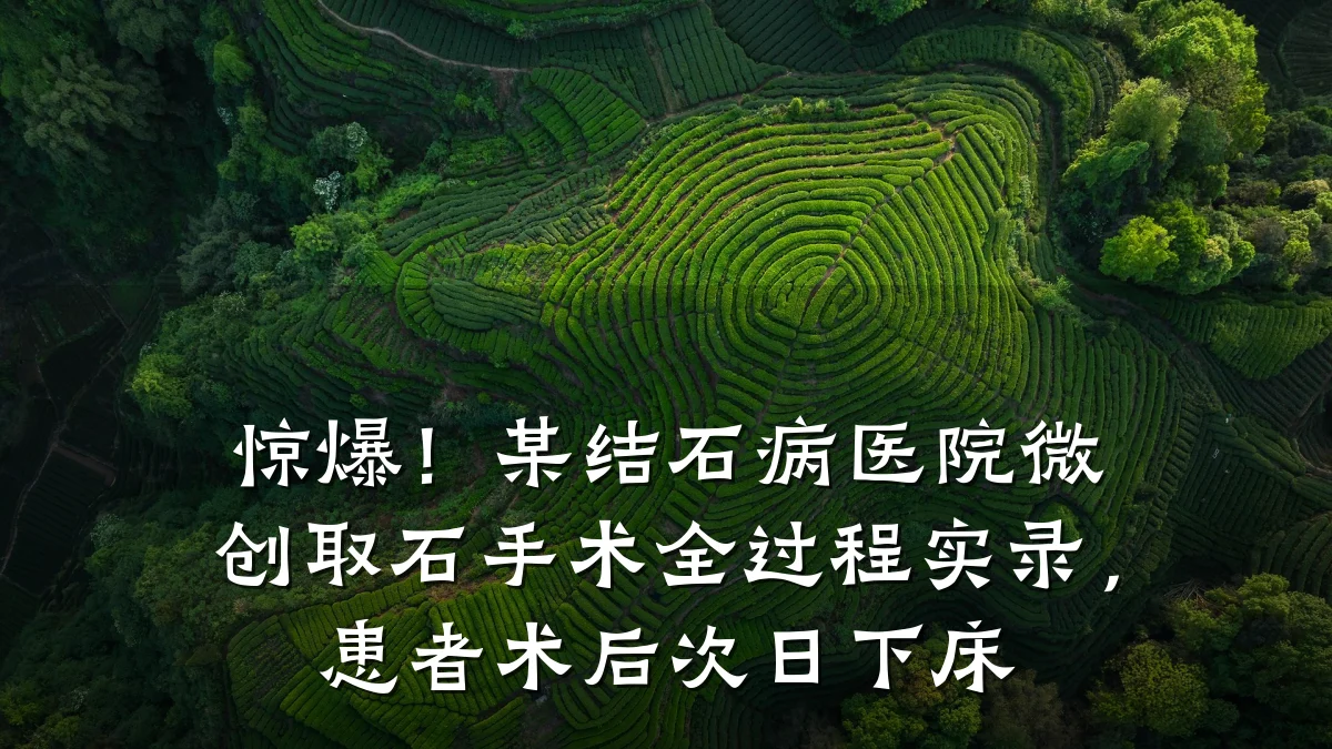 惊爆!某结石病医院微创取石手术全过程实录,患者术后次日下床
